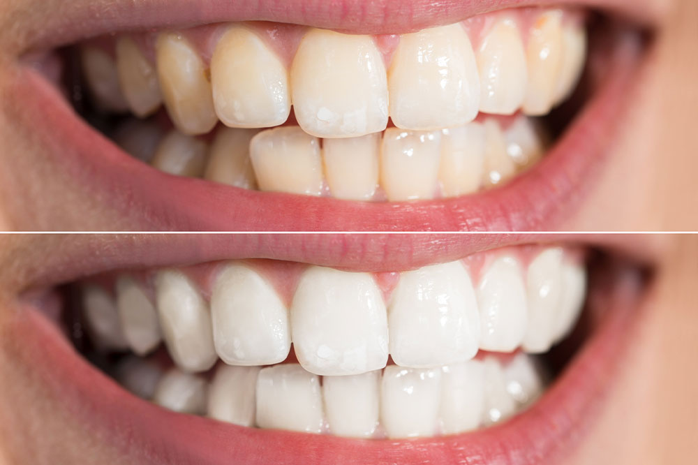 5 Effective Teeth-Whitening Products