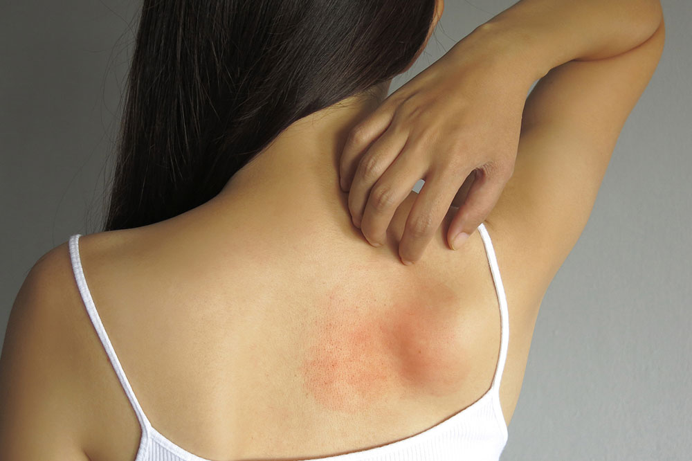 Common Allergy Types and Triggers