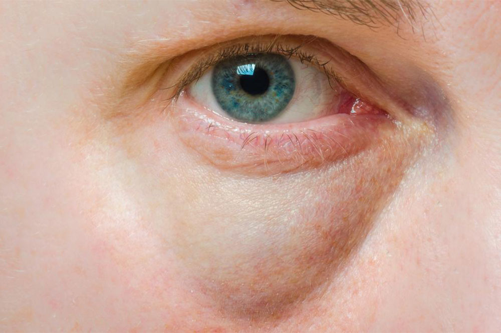 Common Eye Diseases and Symptoms