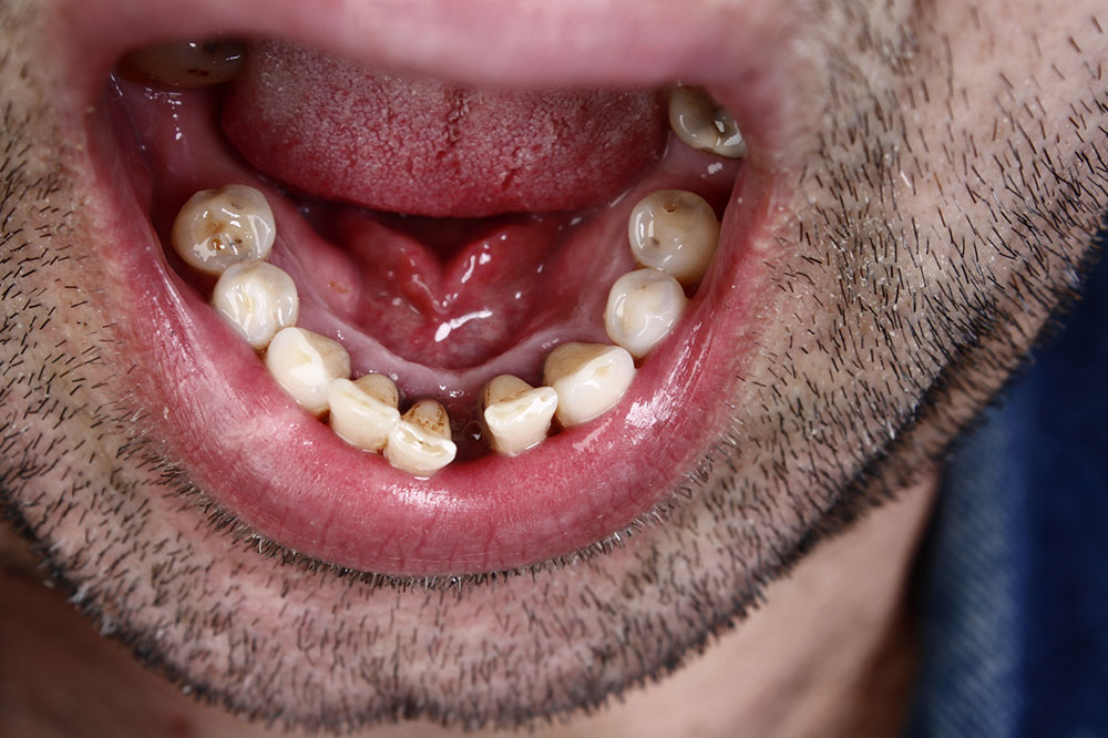 Oral Cancer Warning Signs and Treatment Options